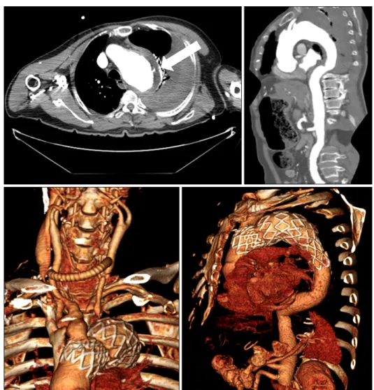 Fig. 1. (A, B) Preoperative CT an- an-giography shows a ruptured (white  arrow) descending thoracic aortic  aneurysm with mediastinal shift due  to a large hemothorax