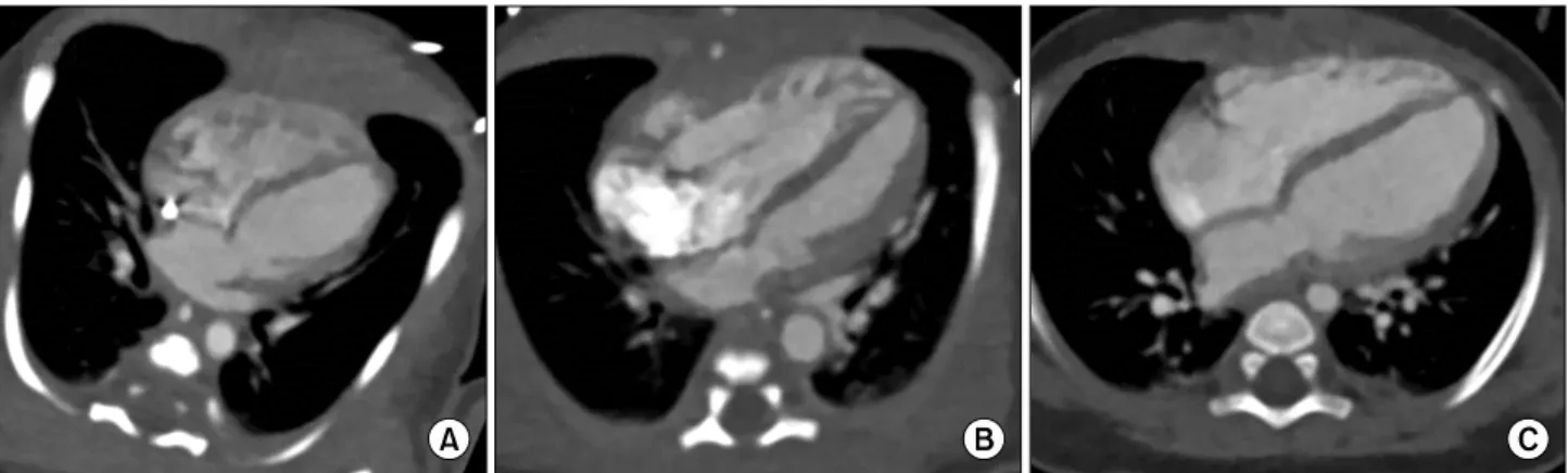 Fig. 3. Serial follow-up of the axial view of the heart. (A) On two days after the birth, diffuse thinning of LV wall is found