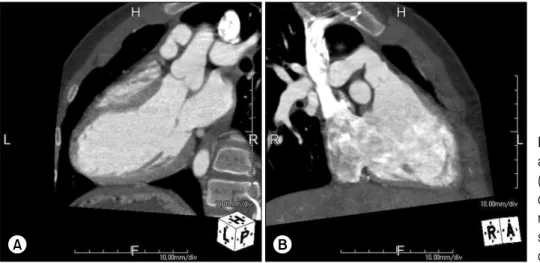 Fig. 1. On a computed tomography  angiogram at the 12-year follow-up. 