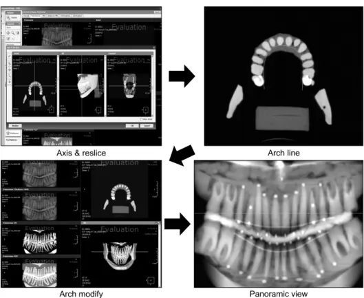 Fig 2. Generation of panoramic view from CBCT data. CBCT, Cone beam computed  tomography