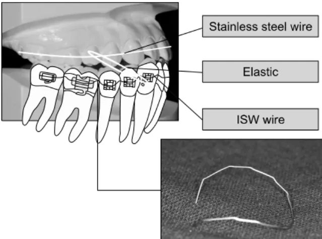 Fig 3. A schematic diagram for ISW tip back and elas- elas-tic treatment. ISW, Improved superelaselas-tic wire.
