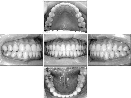 Fig 6. Panoramic, PA cephalometric radiographs after treatment, and superimposition of lateral cephalogram: pre Tx (black line) to post Tx (red line).
