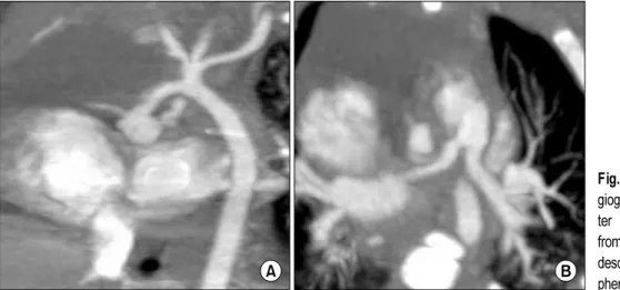 Fig. 2. Computed tomographic an- an-giography images at two months  af-ter birth. (A) Hypoplasia of the aorta  from the sinotubular junction to the  descending thoracic aorta