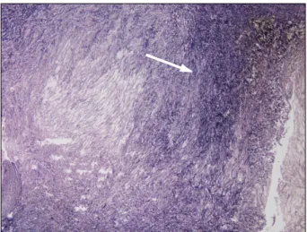 Fig. 4. (A) The two vertical incisions in the aortic sinuses. (B)  Accommo-dation of the bovine pericardial  pat-ches in each sinus of Valsalva.