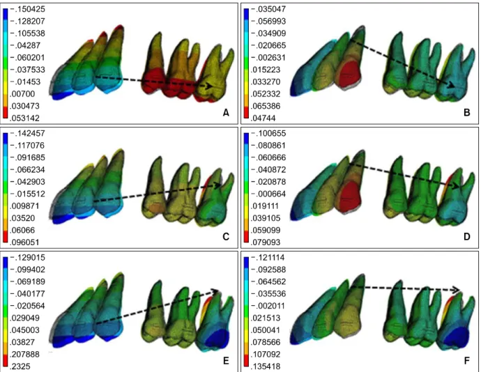 Fig 2. Contour plot of frontal displacement at each condition. A, Length of lever arm is 0 mm and position of retraction hook is at the bracket of the 2nd molar; B, length of lever arm is 20 mm and position of retraction hook is at the bracket of the 2nd m