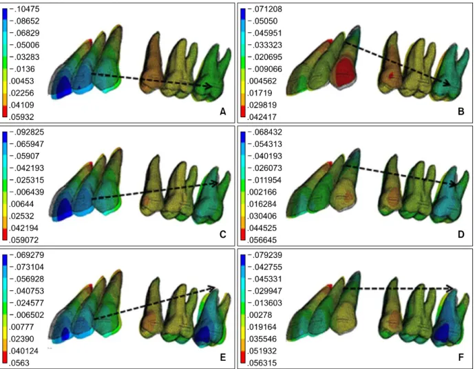 Fig 3. Contour plot of vertical displacement at each condition. A, Length of lever arm is 0 mm and position of re- re-traction hook is at the bracket of the 2nd molar; B, length of lever arm is 20 mm and position of rere-traction hook is at the bracket of 