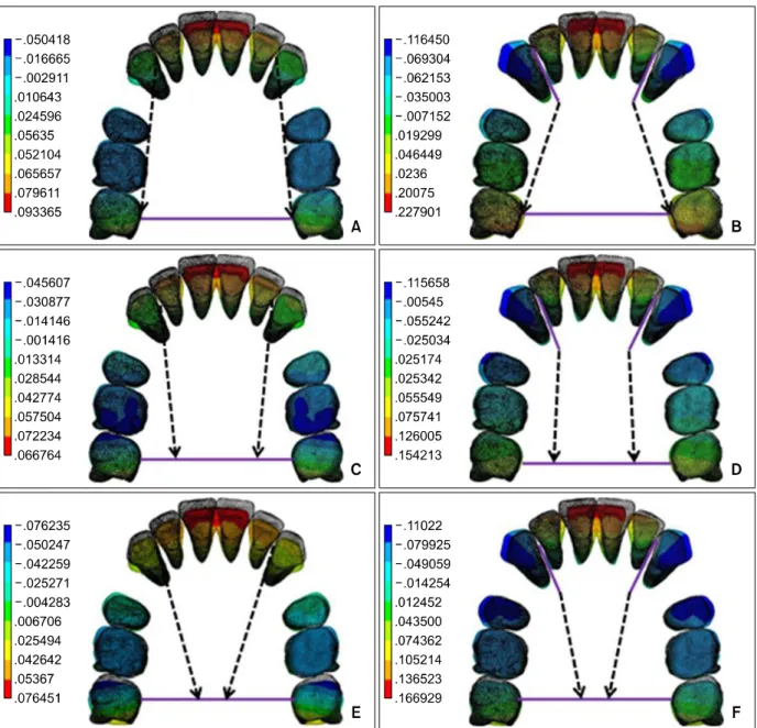 Fig 4. Contour plot of lateral displacement at each condition. A, Length of lever arm is 0 mm and position of retraction hook is at the bracket of the 2nd molar; B, length of lever arm is 20 mm and position of retraction hook is at the bracket of the 2nd m