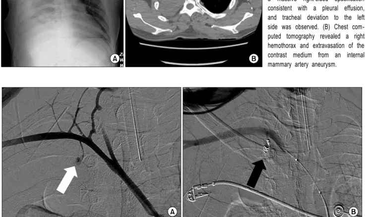 Fig. 1. (A) A chest X-ray confirmed  a massive right-sided opacification  consistent with a pleural effusion,  and tracheal deviation to the left  side was observed