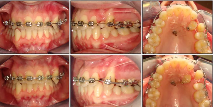Fig 4. Mini-implant placement.