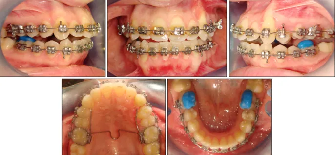 Fig 6. Progress intraoral photographs.
