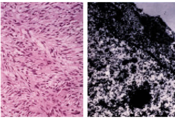 Fig. 3. A: Left atrial s arcoma is taken out with a s poon. B: The s arcoma res embles a mucoid mas s with foca l hemorrhage .