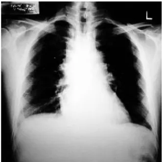 Fig. 2. Che s t CT s hows s ubcuta ne ous e mphys e ma on a nte rior che s t wa ll a nd a bnorma l s oft tis s ue conta ining ga s in a nte rior me dia s tinum