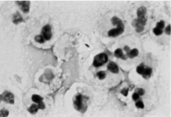 Fig . 3. S me a r of me dia s tina l e xuda te from pa tie nt s howing non- s pore - forming gra m- ne ga tive ba cilli a nd nume rous infla mma tory ce lls (Gra m s ta in, x1000).