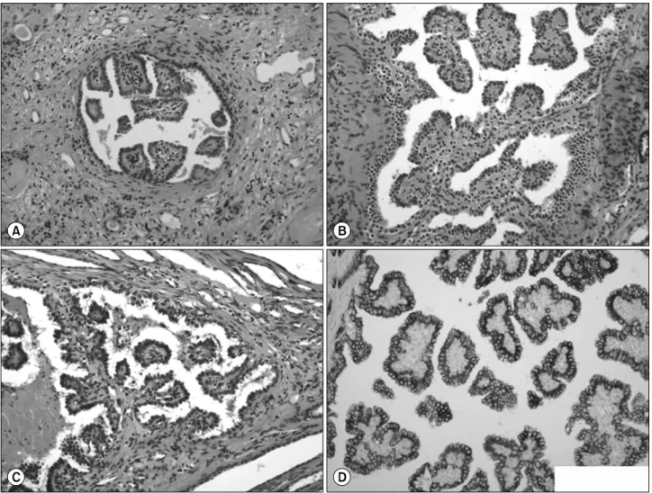 Fig. 2. Pathologic findings in the parenchyma of polycystic kidney. (A∼C) Light microscopy shows papillary proliferation of bland  epithelial cells (HE stain, ×200)