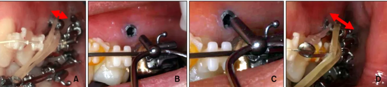 Fig 2. Geometric design of the two-component  mini-implant system. 