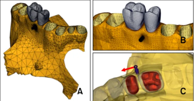 Fig 3. A, Schematic illustrations of the FE models con- con-taining the maxilla, maxillary first molar, maxillary  sec-ond premolar, and mini-implant; B, magnified images of  the models containing the mini-implant, first molar, and second premolar; C, the 