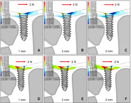 Fig 6.  A to C, Contour plots of the minimum principal (compressive) stress to the bone after a 2 N lateral force is  applied; D to F, contour plots of the maximum principal (tensile) stress to the bone after a 2 N lateral force is applied.