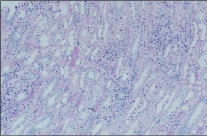 Fig. 3. There are interstitial mononuclear and polymorphonuclear cell infiltrates in the areas of tubular damage (PAS, ×200).