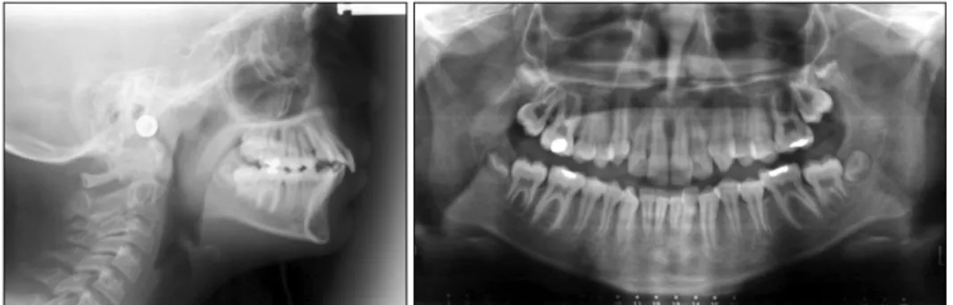 Fig 3. Pretreatment lateral cephalometric and panoramic radiographs of the case.