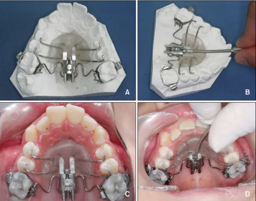 Fig 5. Occlusal views of the Frog Appliance. A, During activation; B, on the dental cast and immediately after the cementation (C,  D).
