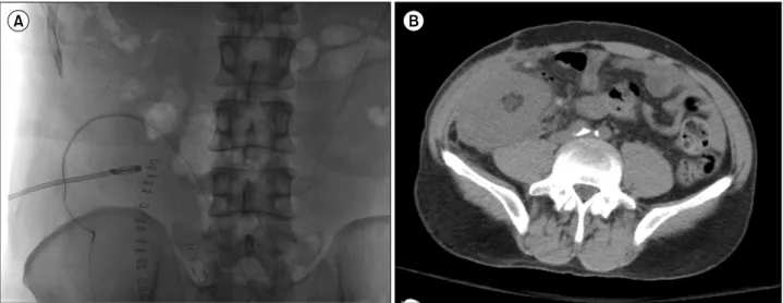 Fig. 3. (A) Plain film showing pigtail drainage in the hematoma location. (B) Computed tomographic image showing the improvement  after the drainage procedure: decreased fluid collection around the transplanted kidney in the right iliac fossa.