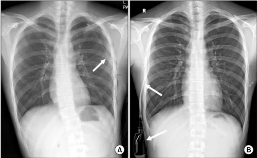 Fig. 1. Thoracic Egg catheter.