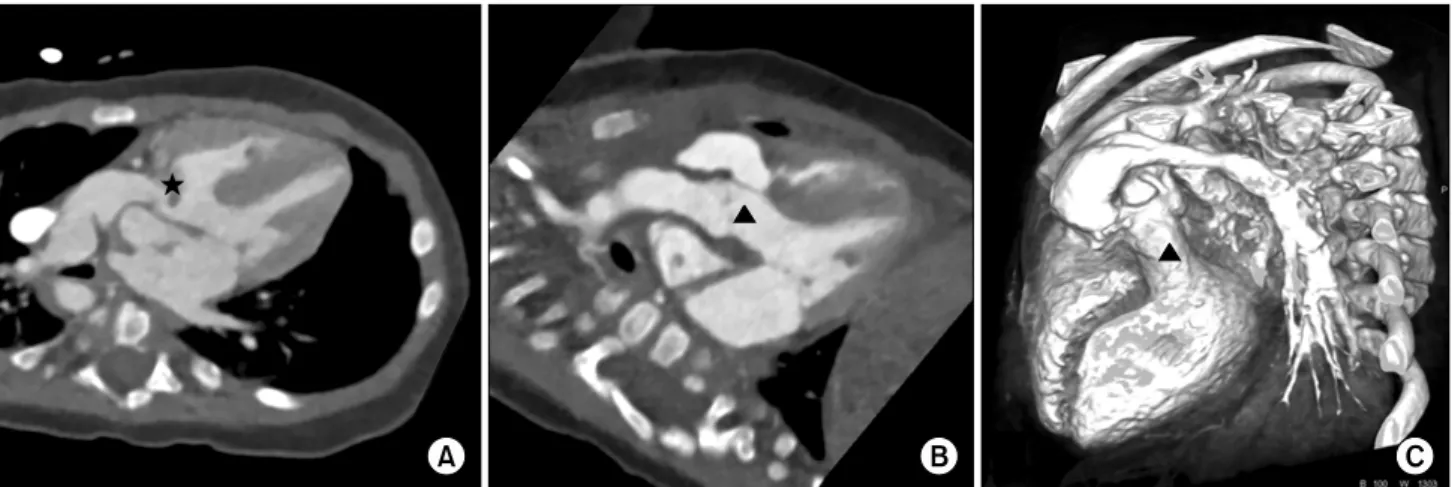 Fig. 1. Case 1: double outlet right ventricle with ventricular septal defect and pulmonary stenosis