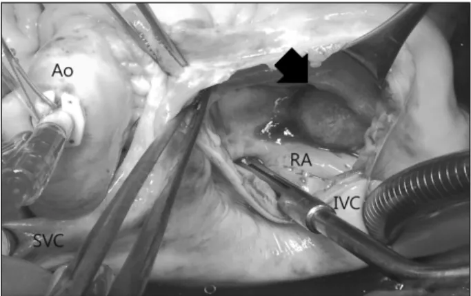 Fig. 2. Intraoperative finding shows the mass (arrow) attached to  the septal leaflet of tricuspid valve without stalk