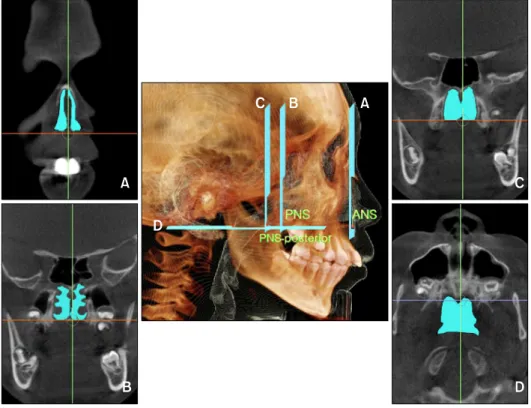 Fig 2. Reference planes and the cross-sectional area measurements of the upper airway