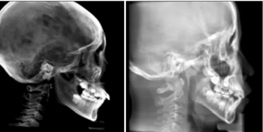 Fig 3. Upper airway volumetric measuremets. To isolate the space of the airway, the threshold value was set at a  range of −1,024 to −300 Hounsfield units