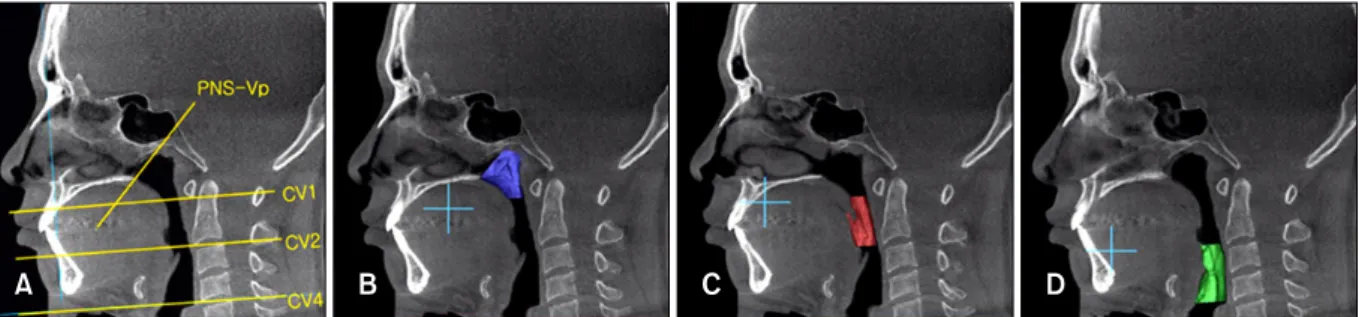 Fig 1. Three dimensional image and MPR (multiplanar projection reformat) overlay views of airways