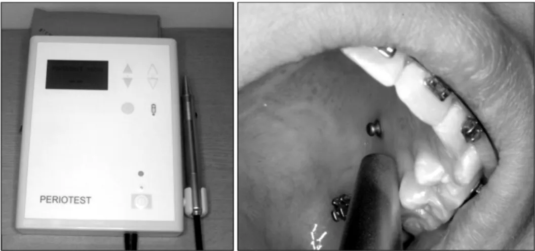 Fig 1. Periotest (Siemens, Bensheim, Germany) and clinical application for the mobility test of mini-implants