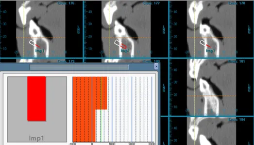 Fig 2. Bone mineral density calibration procedure. The scanned images were reconstructed to a transaxial image for  each occlusal plane of the maxilla and mandible, and the average bone mineral density inside of cylindrical area (red box; diameter, 2 mm; d
