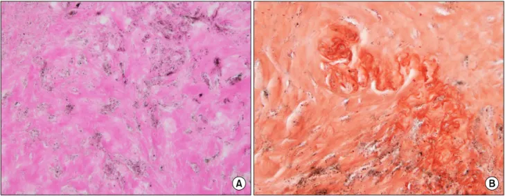Fig. 3. Amorphous eosinophilia and positive Congo red staining were found in the pulmonary nodule