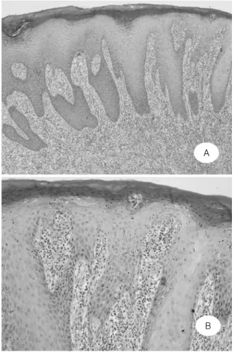 Fig.  3.  There  are  (A)  psoriasiform  epidermal  hyperplasia,  parakeratosis  (x  40,  H  &amp;  E),  and  (B)  band-like  lymphoplasmacytic  dermal  infiltration  (x  100,  H  &amp;  E).