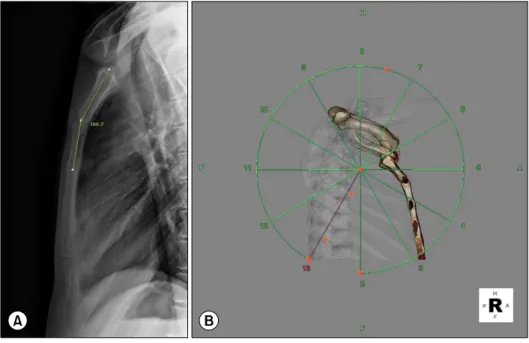 Fig. 1. Dislocated sternoclavicular  joint on lateral view. (A) Angle of  Louis 160’ and (B) reconstruction  view on computed tomography.