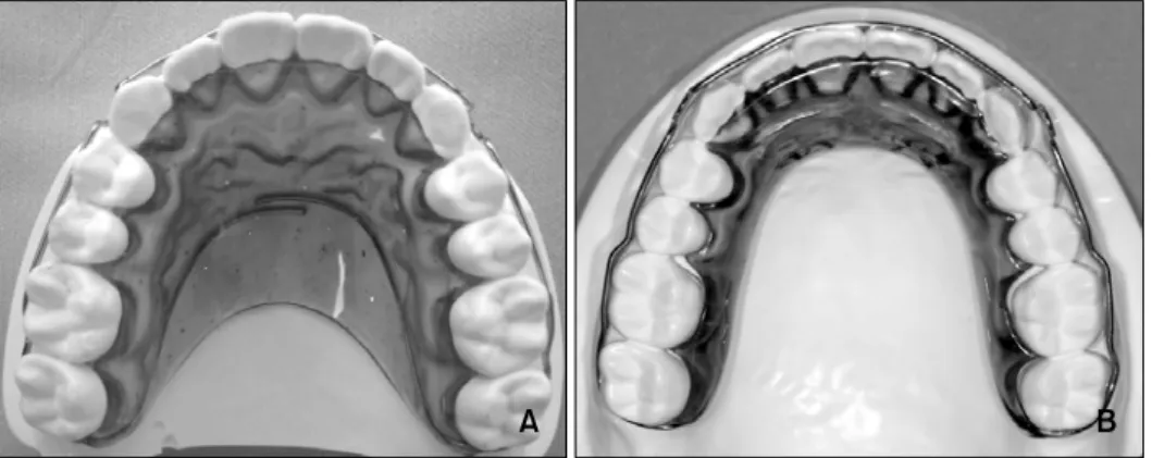 Fig 1. Removable maxillary retainers used in this study. A, The conventional wraparound retainer (CWR) that fully  covers the palate with an acrylic plate and highly polished surface