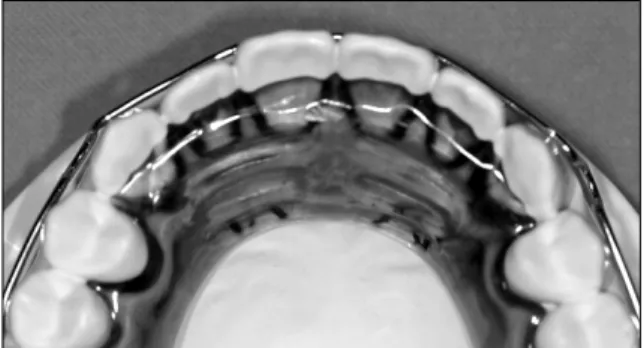 Fig 2. The formation of anatomic rugae with a rough  surface on the anterior region of the base plate.