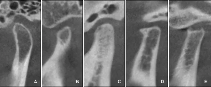 Fig 1. Different type of condylar shapes in cone beam computed tomography sagittal imaging (A, Normal; B, flat- flat-tening;  C, sclerosis; D, osteophyte; E, erosion).