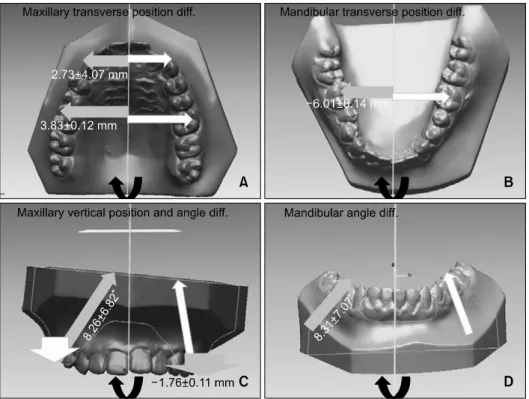 Fig 3. The tooth of maxillary and mandibular canine and first molars of facial asymmetry individuals were compen- compen-sated, sotransverse, vertical position and angle showed deviated/non-deviated side differences