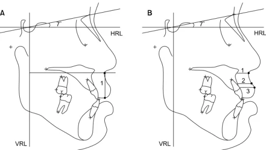 Fig 4. Upper lip length and thickness. HRL, Horizontal reference line; VRL, vertical reference line;  A, 1, Subnasale  to stomion superius; B, 1, subnasale to subnasale horizontal; 2, superior labial sulcus to superior labial sulcus  hori-zontal; 3, labral