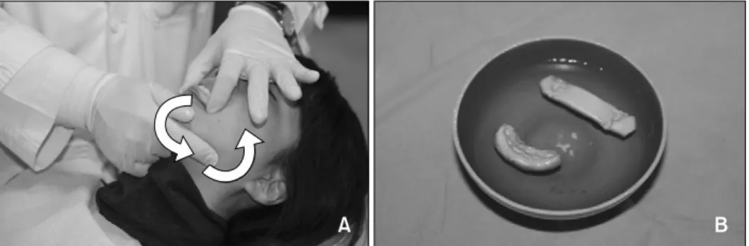 Fig 1. Registration of the centric relation wax bite. A, Guiding the mandible using the tripoding method; B, centric relation wax bite (anterior and posterior portion).