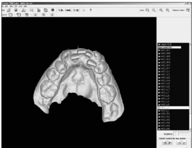 Fig 1. Measurements of tooth size and dental arch width of a laser scan digital model