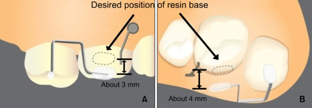 Fig  3. Bonding Procedure of NiTi Scissors-bite corrector. A, Buccal aspect; B, occlusal aspect