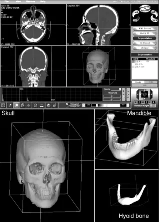 Fig 1. Procedure of 3D image reconstruction using  V-works TM  4.0 (Cybermed, Seoul, Korea)