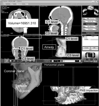 Fig 4. Measurements of Hyoid bone. The 3-dimen- 3-dimen-sional position of hyoid bone was obtained by  measur-ing the distances between H point and Coronal,  Midsagittal, and Horizontal planes