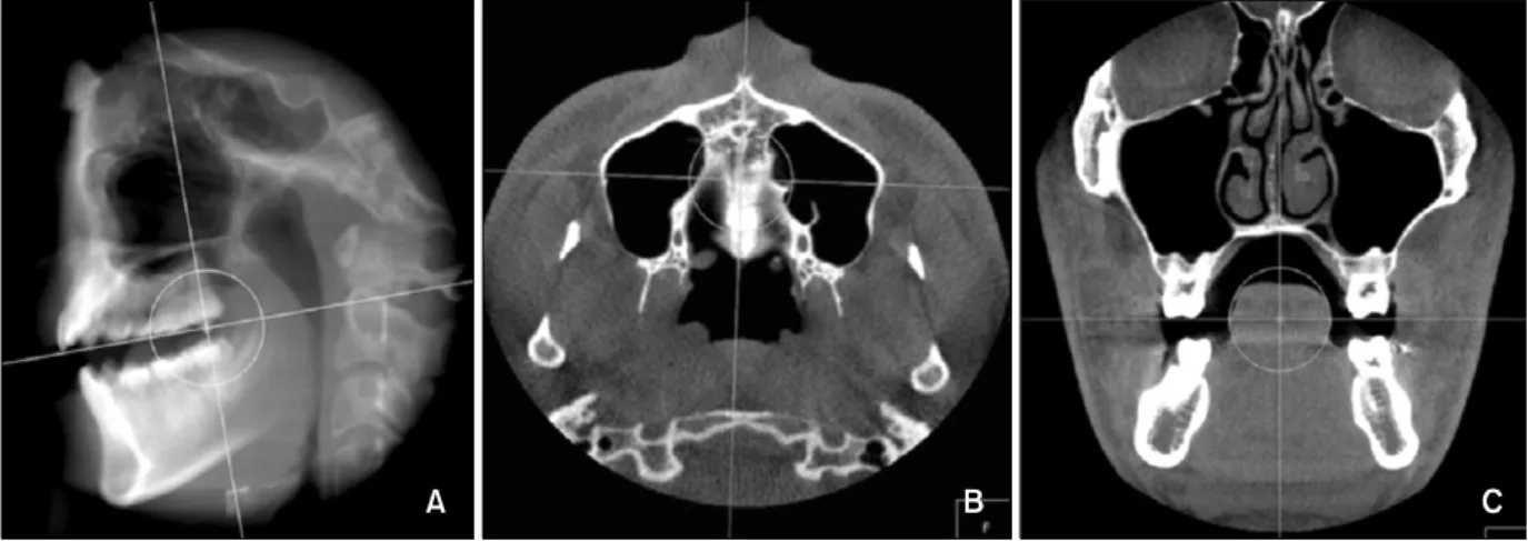 Fig 1. Adjustment of reference lines.  A, Occlusal plane in sagittal section - from incisal edge of maxillary central in- in-cisor to mesiobuccal cusp tip of maxillary 1st molar; B, anterior posterior line in axial section - from ANS to PNS;