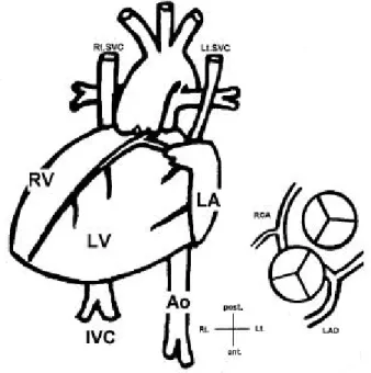 Fig. 3. Opera tive finding of hea rt pos ition a nd coronary anatomy.