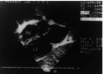 Fig. 5. Follow- up e choca rdiogram s howing no left ventricular outflow tract obs truction(arrow)