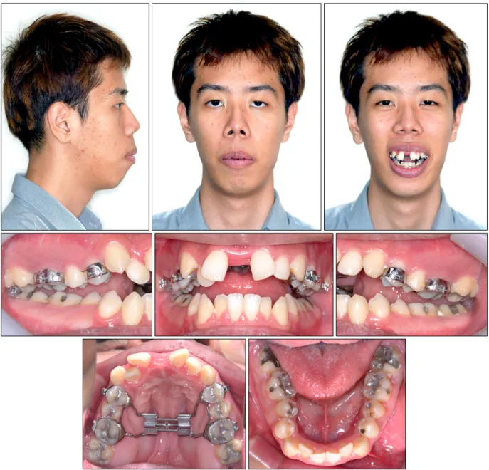 Fig 4. Photographs after 28 day expansion of the maxilla and mandible.